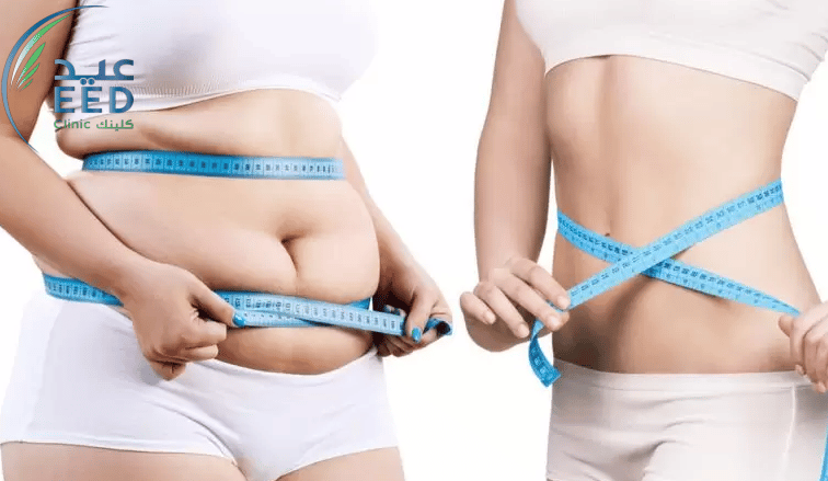 فوائد عملية شفط الدهون