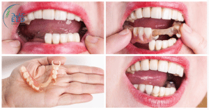الفرق بين تركيب الأسنان المتحركة والثابتة