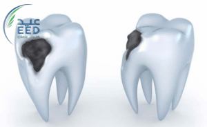 اسباب واعراض وعلاج تسوس الاسنان