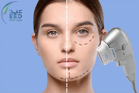 تقنية الترافورمر لشد الوجه